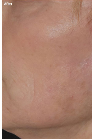 patient after laser skin treatment in naples