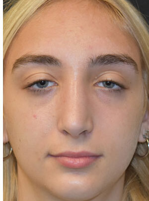 woman after rhinoplasty in Naples