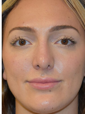 woman after Rhinoplasty in Naples