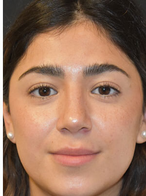 woman after rhinoplasty in Naples