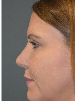 woman after rhinoplasty in Naples