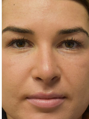 woman after rhinoplasty in Naples