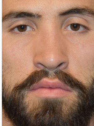 man after rhinoplasty in Naples